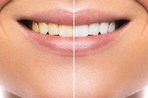 10 bí mật giúp răng bạn luôn trắng sáng