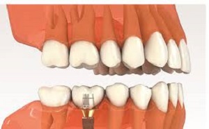 Bệnh viêm quanh implant ở bệnh nhân trồng răng implant