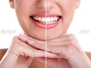 Cạo vôi răng định kỳ bảo vệ sức khỏe răng miệng cho gia đình bạn