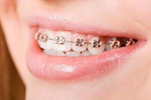 Chỉnh răng móm bằng phương pháp niềng răng