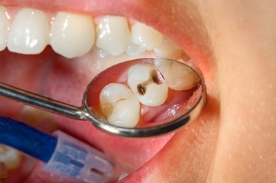 Chữa tủy răng tại quận 10