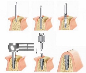 Có được uống rượu bia sau khi cấy ghép răng implant không
