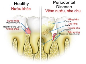 Dấu hiệu của bệnh viêm nha chu