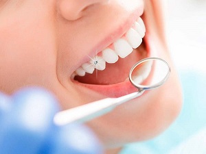 Dịch vụ đính đá răng thẩm mỹ
