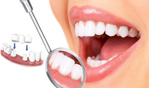 Giai đoạn nào nên bọc răng sứ