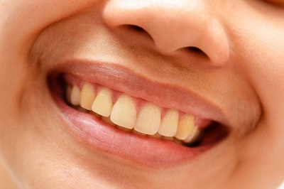 Làm sao để làm trắng răng bị ố vàng