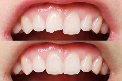 Nên và không nên làm gì sau khi trám răng thẩm mỹ