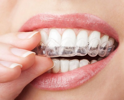 Những điểm bạn cần lưu ý trước và sau khi niềng răng