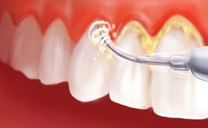 Những điều cần biết về bệnh viêm nha chu