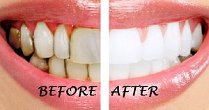 Những loại máy làm trắng răng tại nhà tốt nhất
