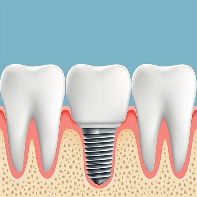 Những  lợi ích của việc trồng implant mang lại