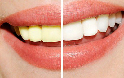 Những nguyên nhân khiến răng bị ố vàng và cách khắc phục