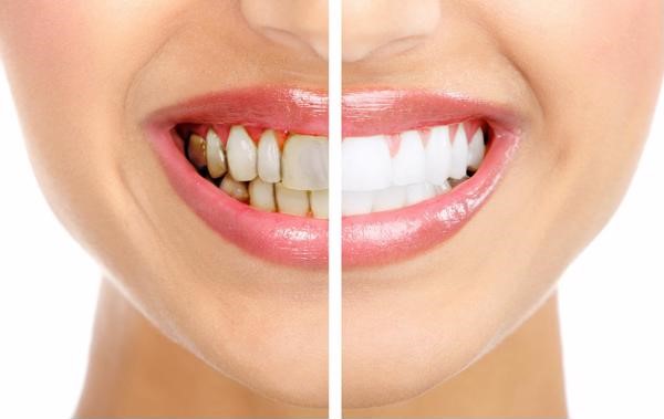 Những thắc mắc thường gặp trước khi tẩy trắng răng