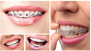 Niềng răng có làm thẳng răng ở trẻ em và người lớn không