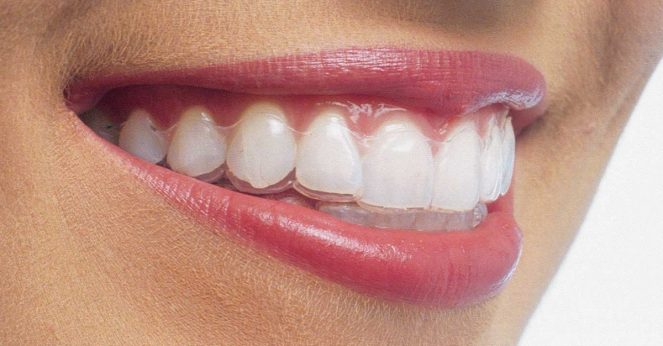 Niềng răng invisalign có hiệu quả không