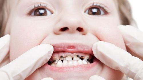 Răng bị đen bên trong