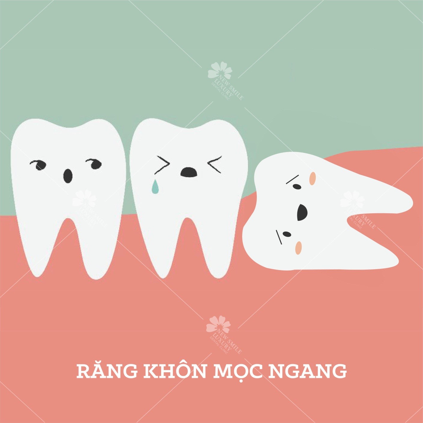 Răng khôn mọc ngầm và những tác hại to lớn mà bạn không biết.