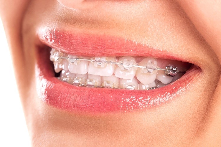 Tác dụng của niềng răng mà bạn nên biết