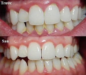 Tác hại của vôi răng Cạo vôi răng có đau hay không