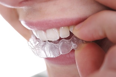 Tẩy trắng răng tại quận 10