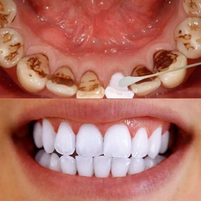 Tẩy trắng răng tại Tân Phú