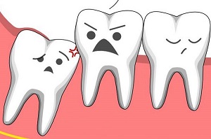 Thời gian để hồi phục sau khi nhổ răng khôn