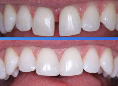 Trám răng thẩm mỹ tại quận 10