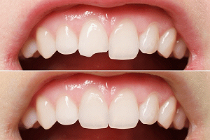 Trám răng thẩm mỹ và những điều cần biết
